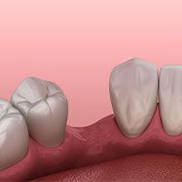 Missing Teeth