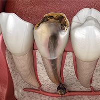 Tooth Decay
