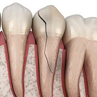 Fractured Teeth