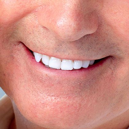 Stronger Teeth